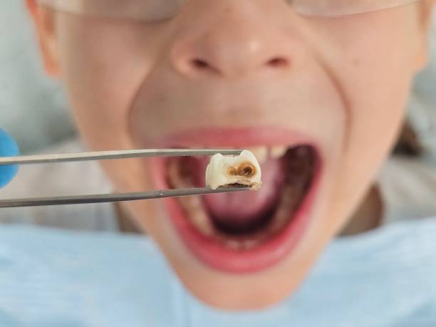 Best Emergency Dental Care for Broken or Chipped Teeth in Olcott, NY